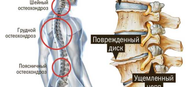 Упражнения при остеохондрозе шейно грудного отдела позвоночника