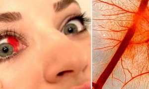 Кровоизлияние в глазу что делать какие капли капать