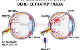 Лечение тромбоз глаза