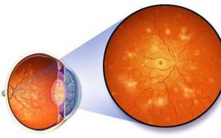 Ангиопатия сетчатки глаза лечение