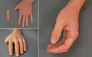 Протезы пальцев рук