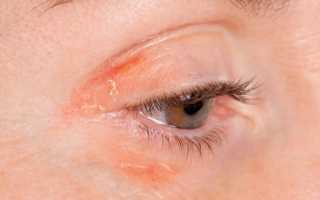 Аллергия на веках глаз лечение