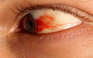 Кровоизлияние в сетчатку глаза