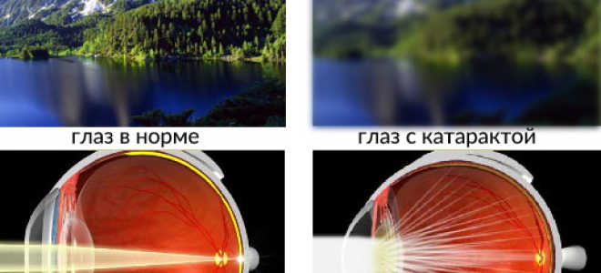 Признаки катаракты в ранней стадии