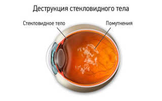 Деструкция стекловидного тела глаза лечение