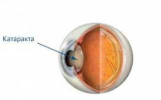 Что такое катаракта глаза и как ее лечить