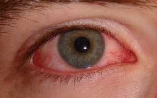 Симптомы инфекции глаз