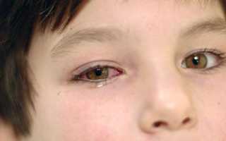 Воспаление сетчатки глаза