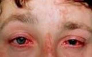 Ожог глаза симптомы