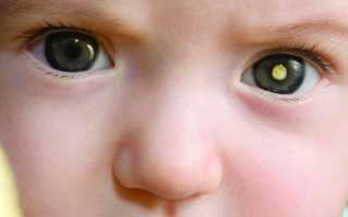 Рак сетчатки глаза