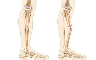 Первая помощь при переломах