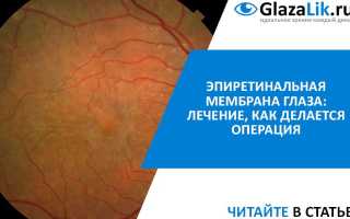 Эпиретинальная мембрана глаза