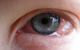 Отек слизистой глаза лечение