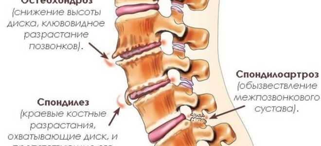 Спондилоартроз пояснично крестцового отдела позвоночника лечение уколы