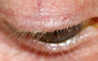 Демодекоз глаз симптомы и лечение