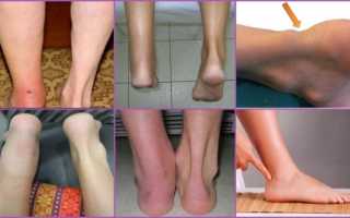 Болезни стопы ног