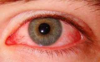 Как убрать красноту глаз в домашних условиях