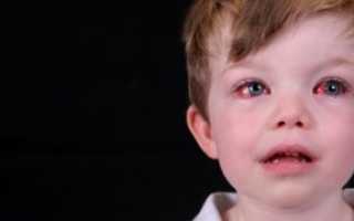 Аллергический конъюнктивит у ребенка