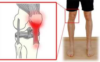 Тендинит коленного сустава лечение